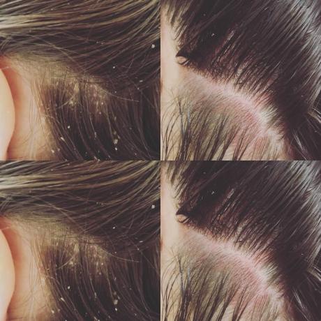 Here is such a result after one treatment scalp exfoliation. It is clear that dandruff does not disappear forever, and peeling should be repeated periodically. How often - all individually.