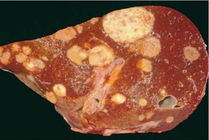 Liver metastases - liver metastases