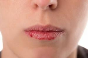 5 tips on how to prevent chapping of lips